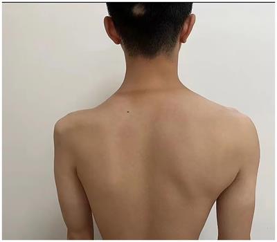Isolated unilateral brachial plexus injury following carbon monoxide intoxication: a case report and literature review